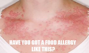 food allergy
